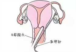 重庆试管找捐卵代怀孕,重庆妇幼可以做供精试管吗？附详细试管流程